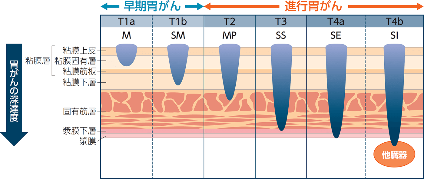 深達度分類